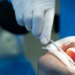 bone grafting dental implants guide