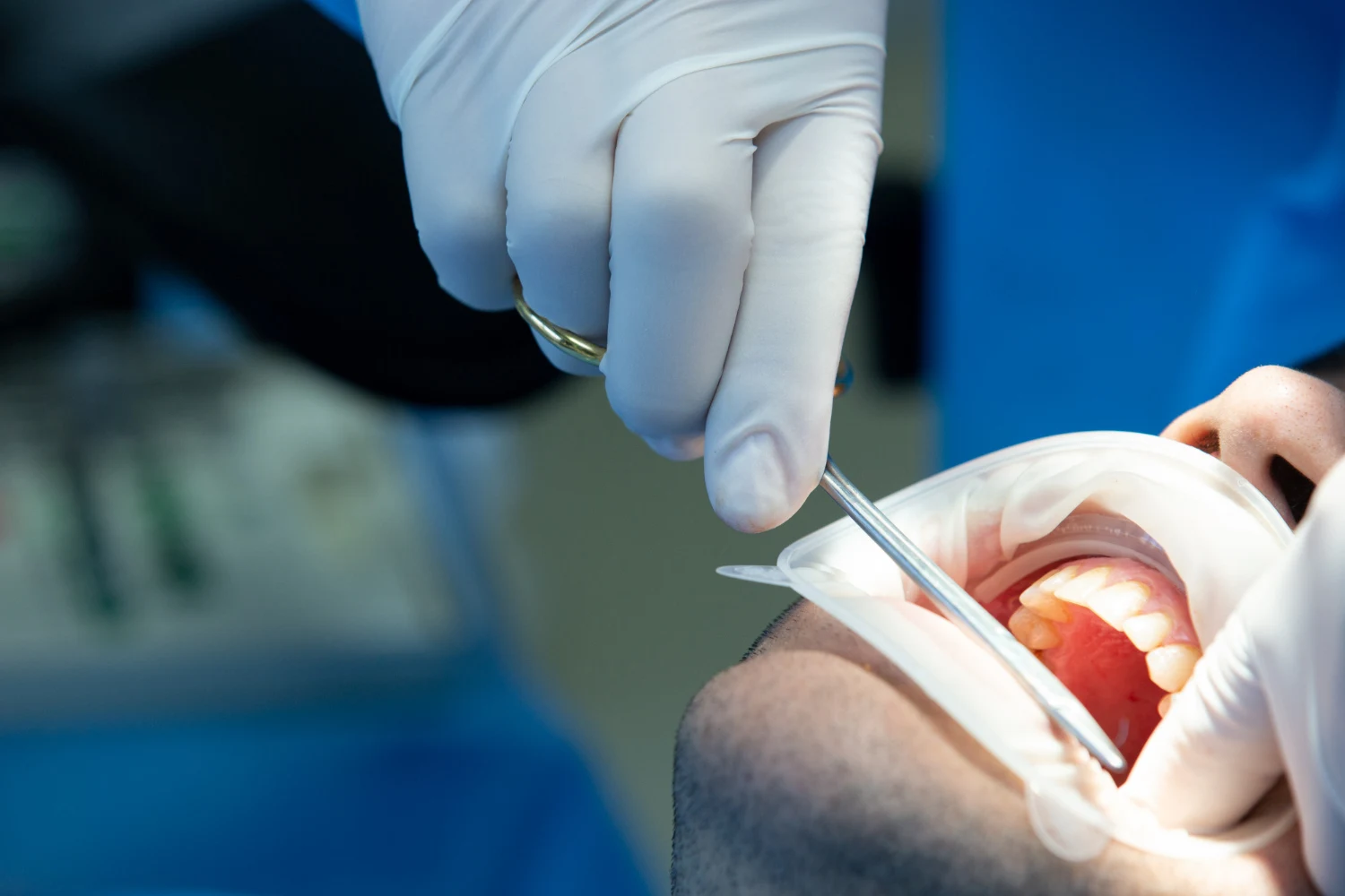 bone grafting dental implants guide